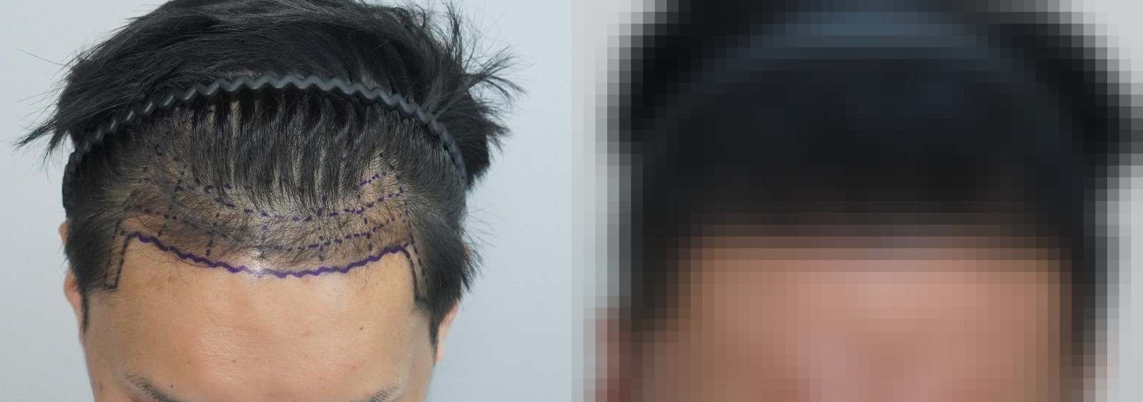 시술 전과 수술 1년 후 모발 상태 비교