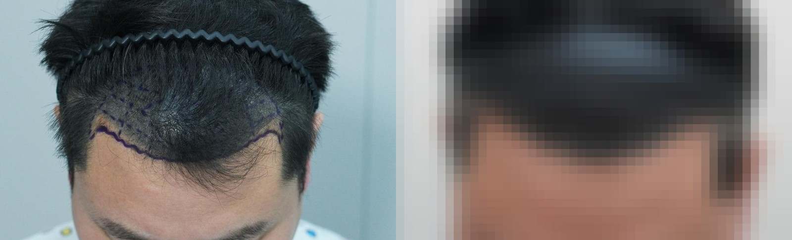 시술 전과 수술 1년 후 모발 상태 비교