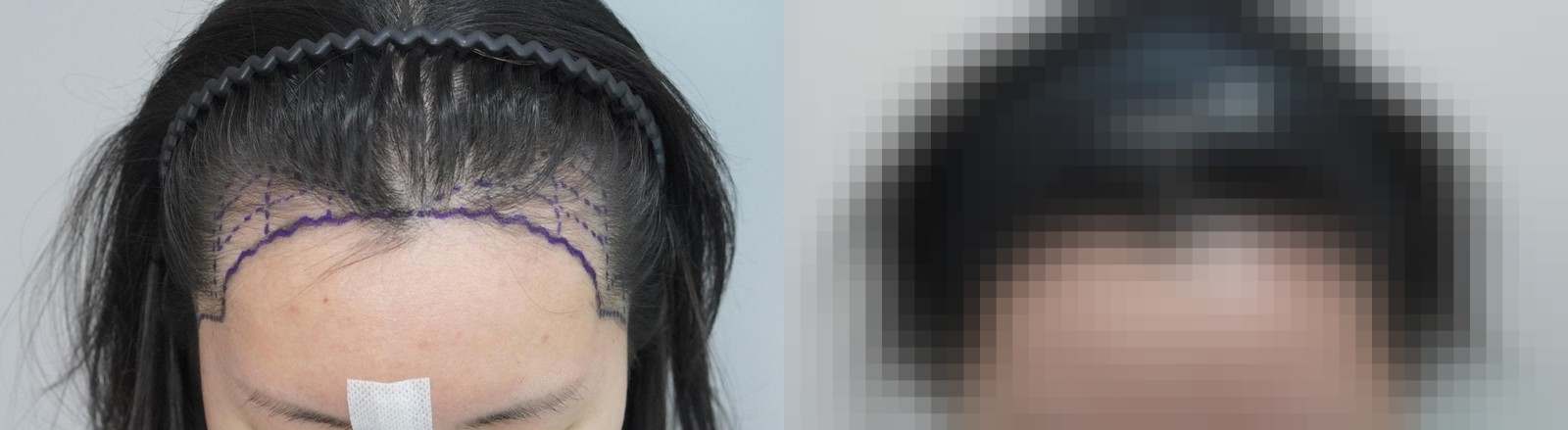 시술 전과 수술 1년 후 모발 상태 비교
