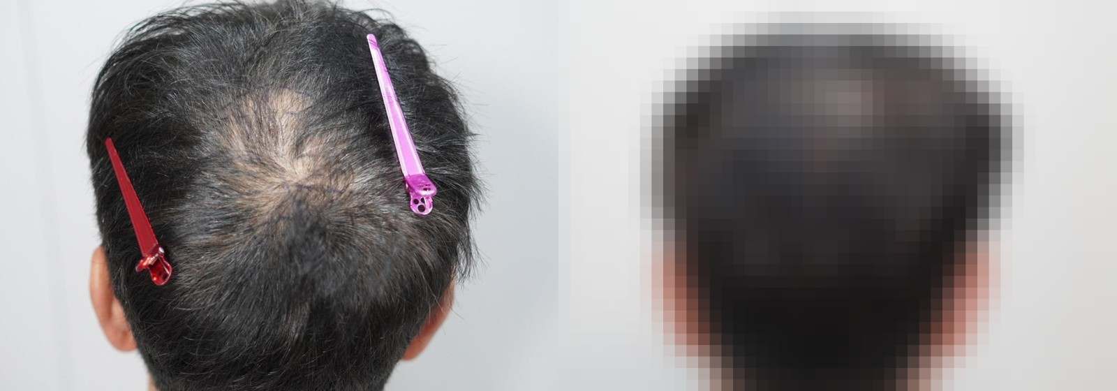 시술 전과 수술 1년 후 모발 상태 비교