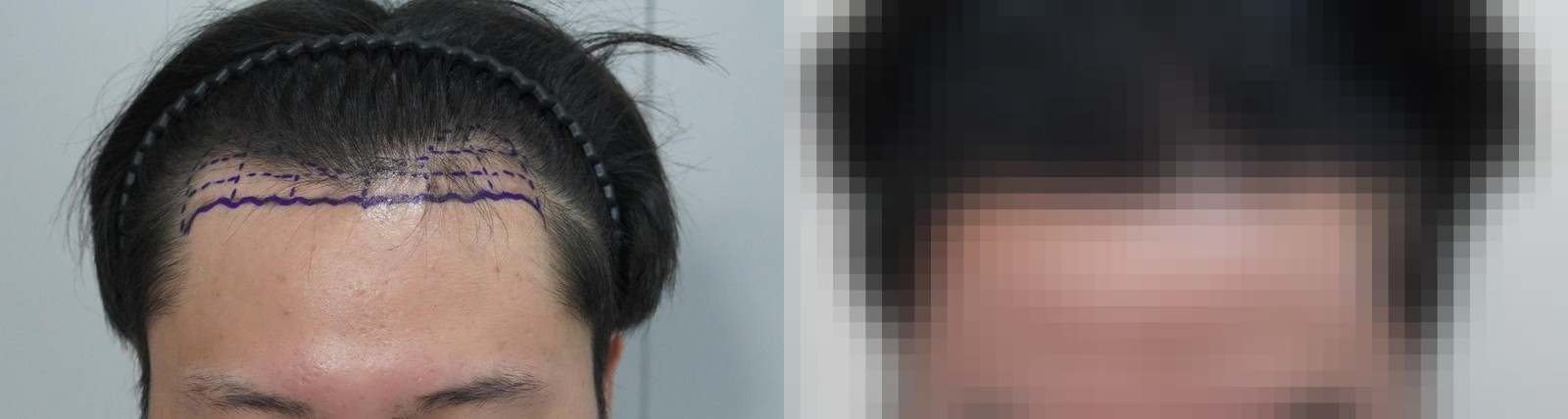 시술 전과 수술 1년 후 모발 상태 비교