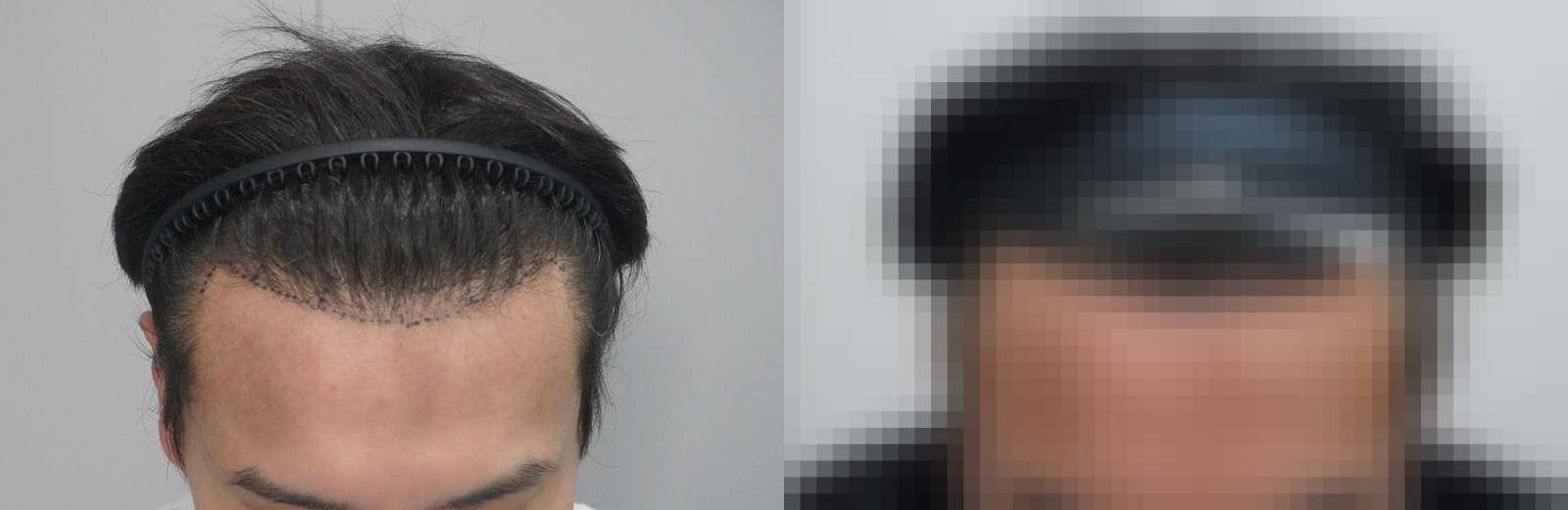 시술 전과 수술 1년 후 모발 상태 비교