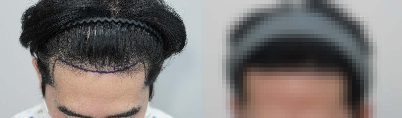 시술 전과 수술 1년 후 모발 상태 비교