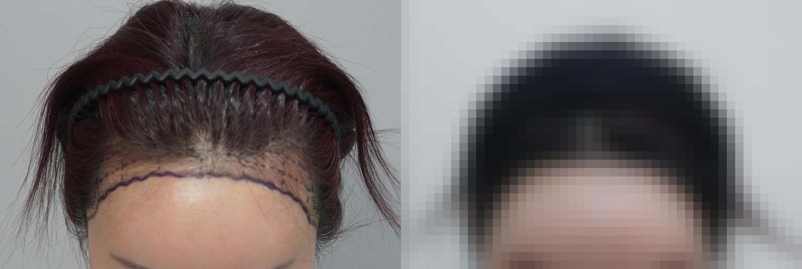 시술 전과 수술 1년 후 모발 상태 비교