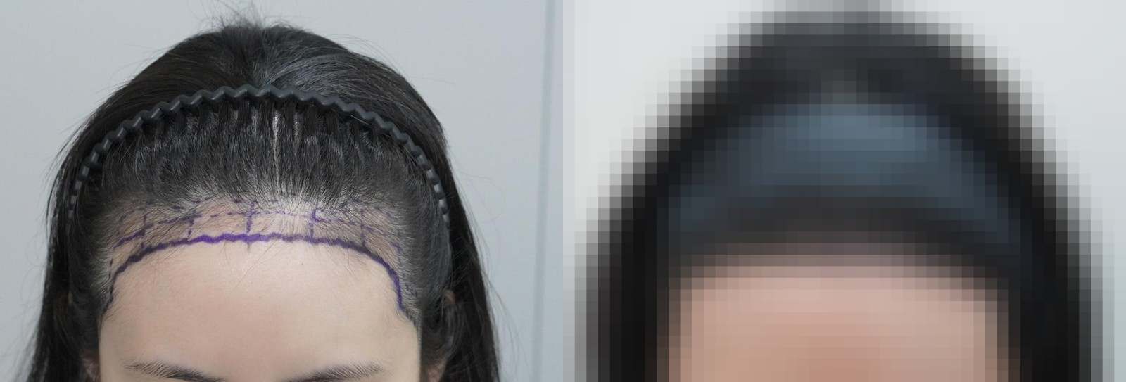 시술 전과 수술 1년 후 모발 상태 비교