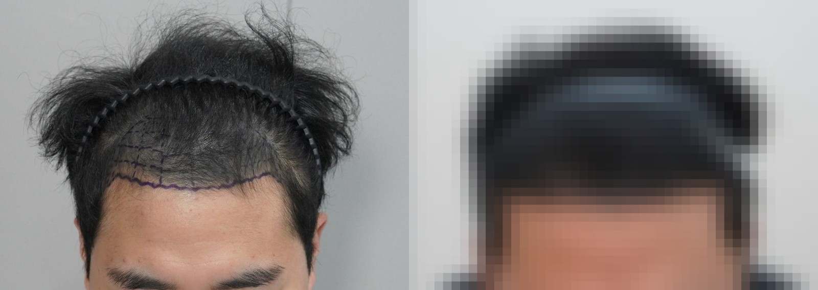 시술 전과 수술 1년 후 모발 상태 비교