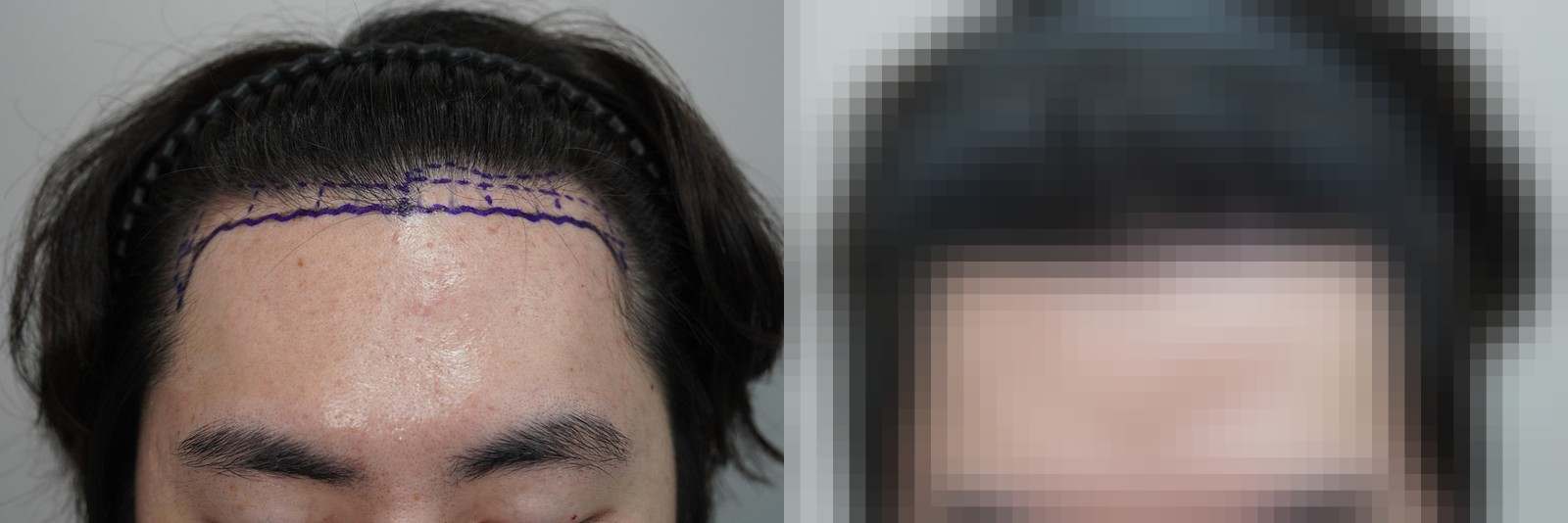 시술 전과 수술 1년 후 모발 상태 비교