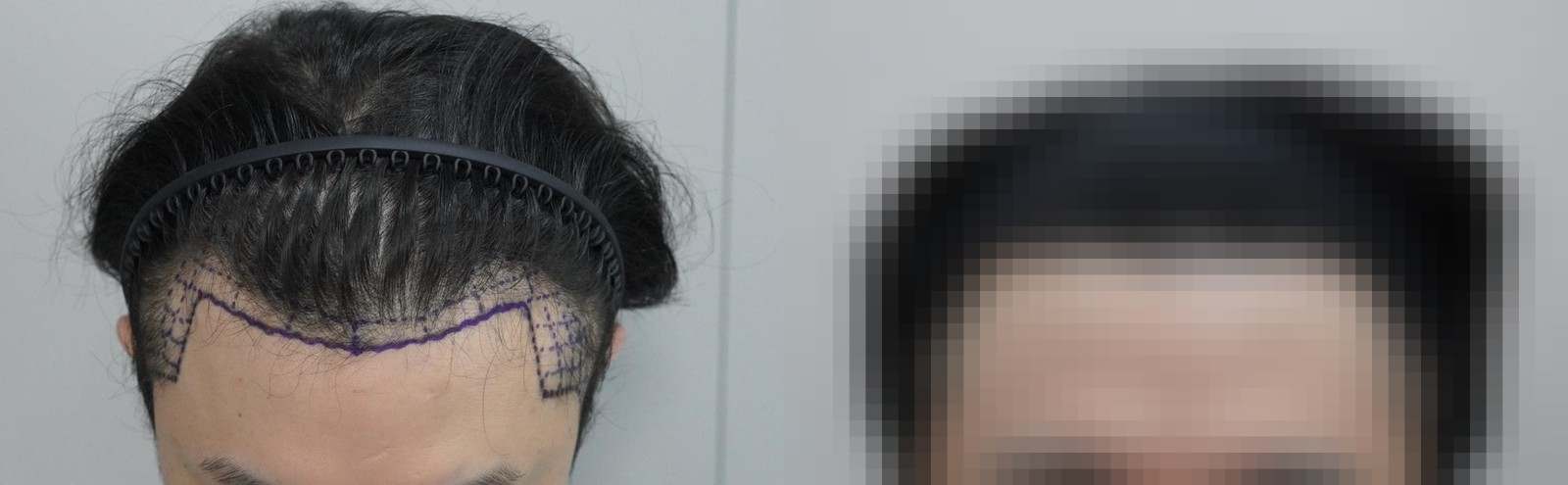 시술 전과 수술 1년 후 모발 상태 비교