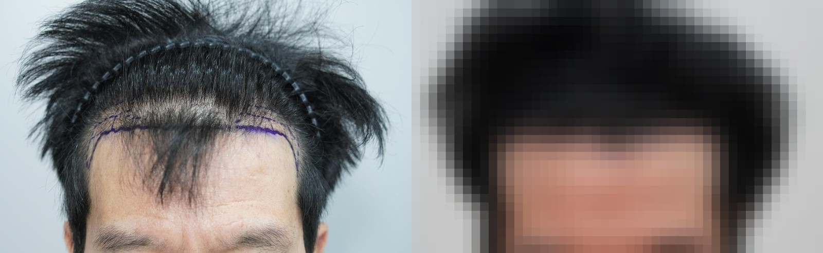 시술 전과 수술 1년 후 모발 상태 비교