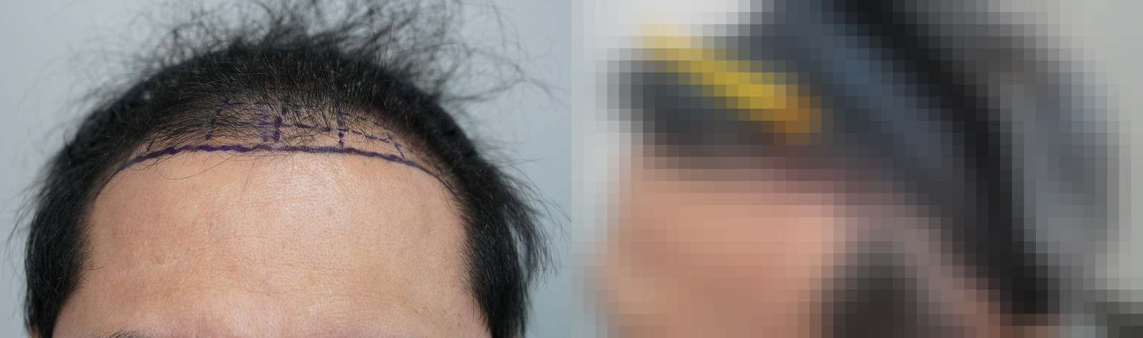 시술 전과 수술 1년 후 모발 상태 비교