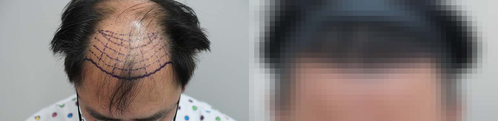시술 전과 수술 1년 후 모발 상태 비교