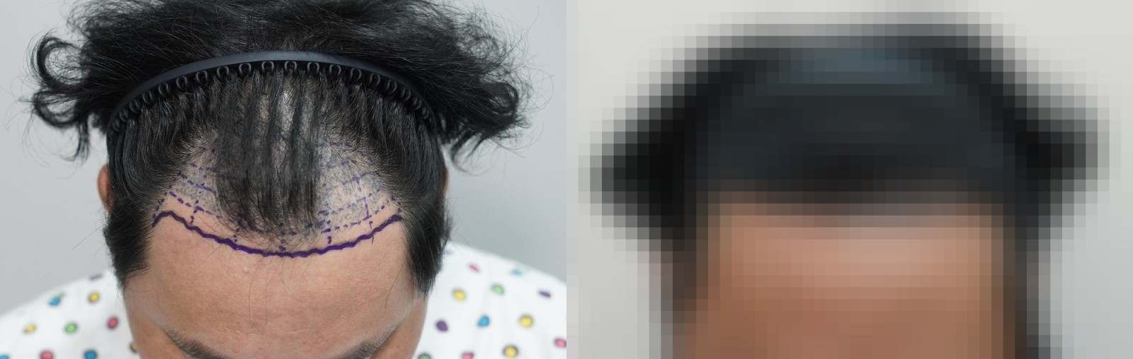 시술 전과 수술 1년 후 모발 상태 비교