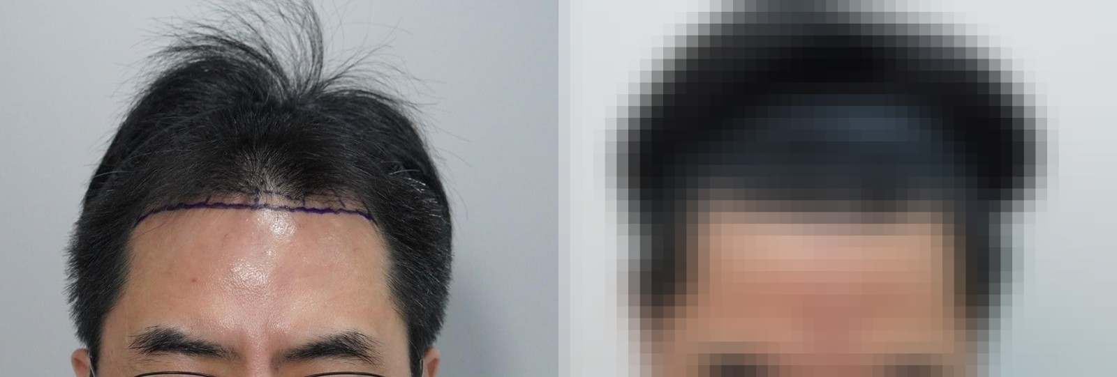 시술 전과 수술 1년 후 모발 상태 비교