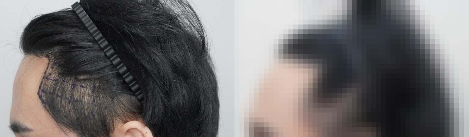 시술 전과 수술 1년 후 모발 상태 비교