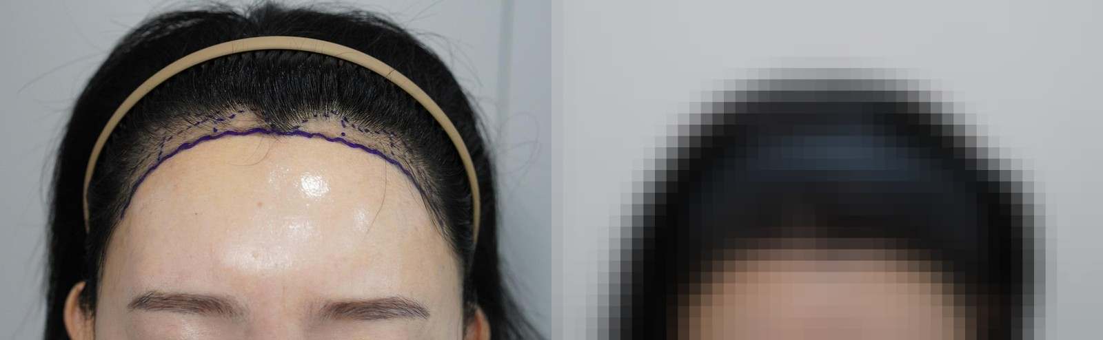 시술 전과 수술 1년 후 모발 상태 비교