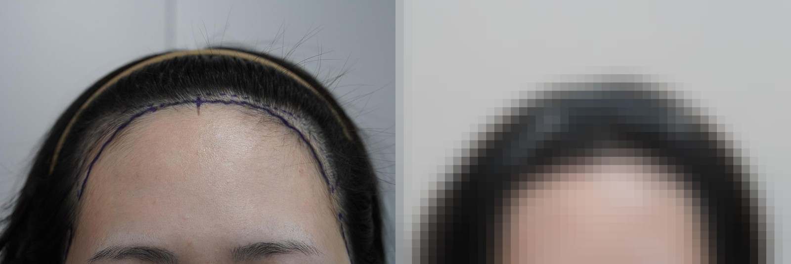 시술 전과 수술 1년 후 모발 상태 비교