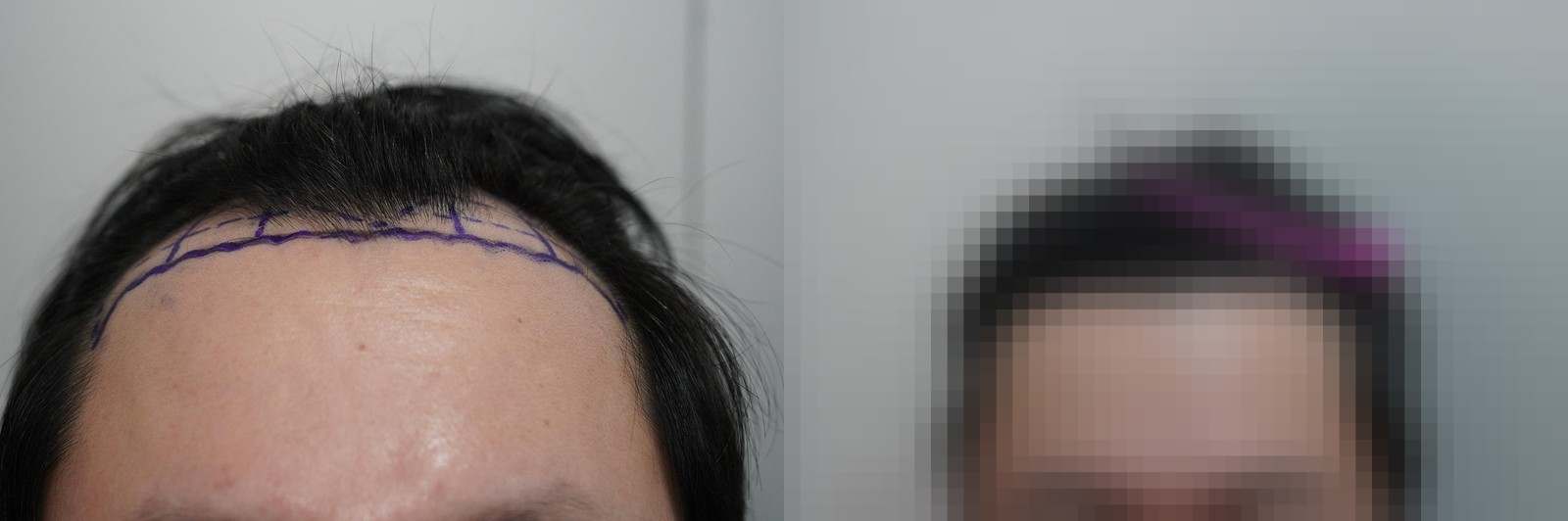 시술 전과 수술 1년 후 모발 상태 비교