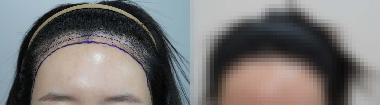 시술 전과 수술 1년 후 모발 상태 비교