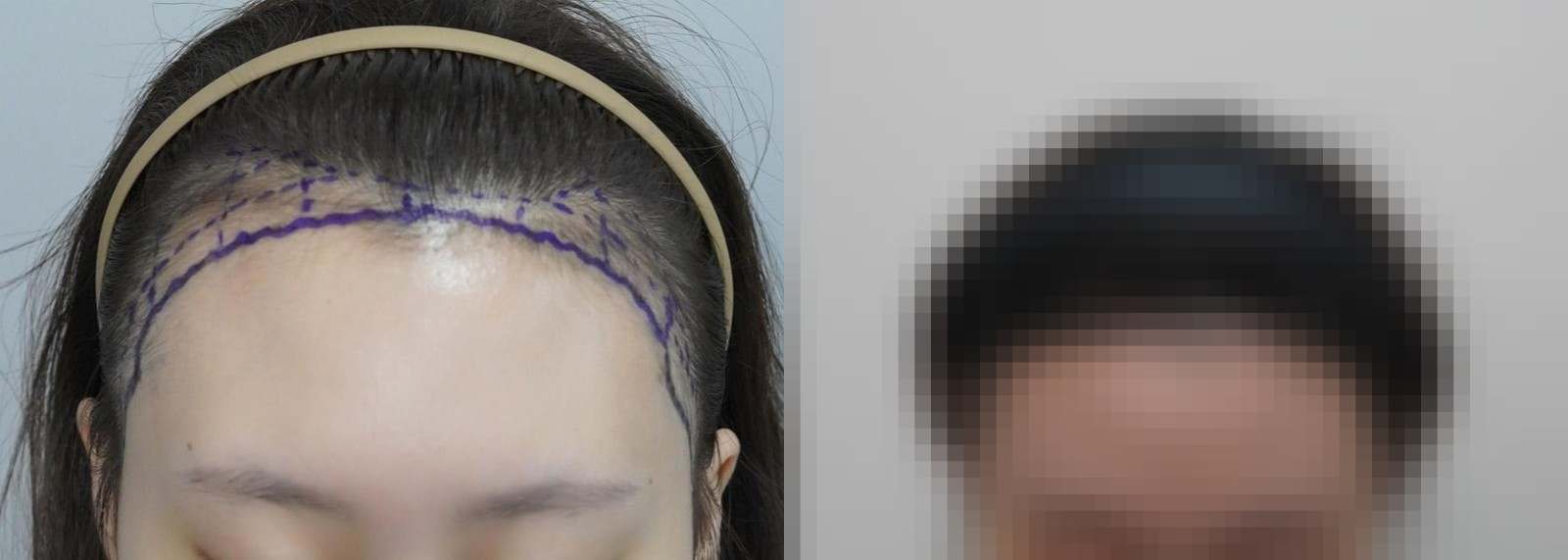 시술 전과 수술 1년 후 모발 상태 비교