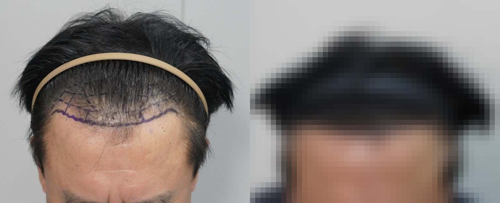 시술 전과 수술 1년 후 모발 상태 비교