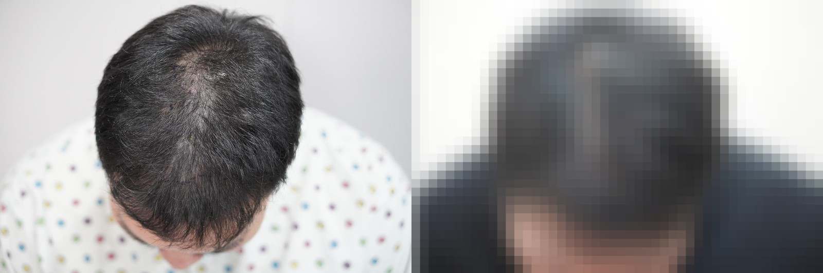 시술 전과 수술 1년 후 모발 상태 비교