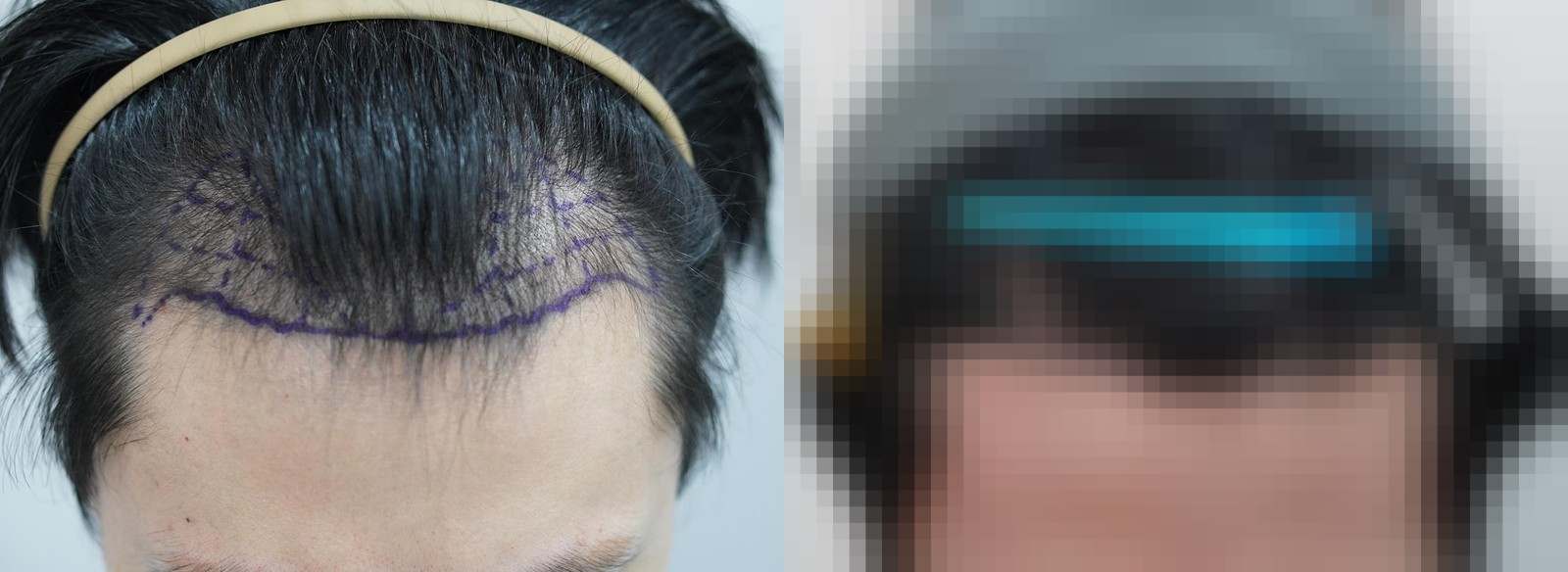 시술 전과 수술 1년 후 모발 상태 비교