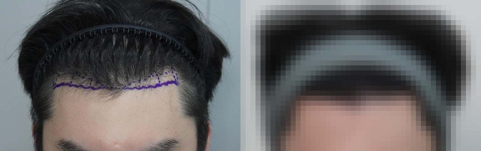시술 전과 수술 1년 후 모발 상태 비교