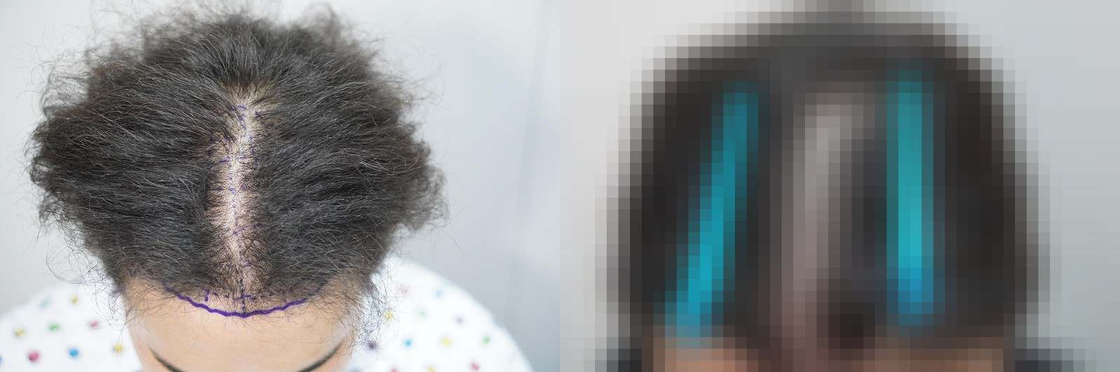 시술 전과 수술 1년 후 모발 상태 비교