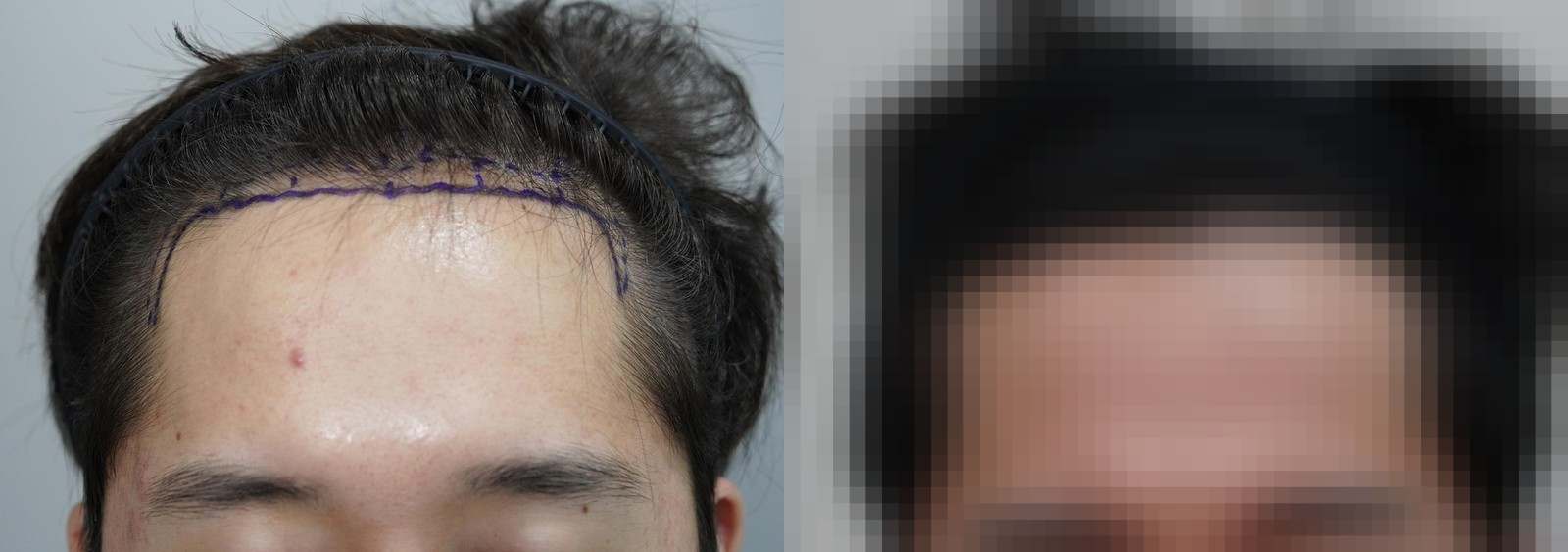 시술 전과 수술 1년 후 모발 상태 비교