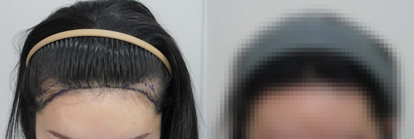시술 전과 수술 1년 후 모발 상태 비교