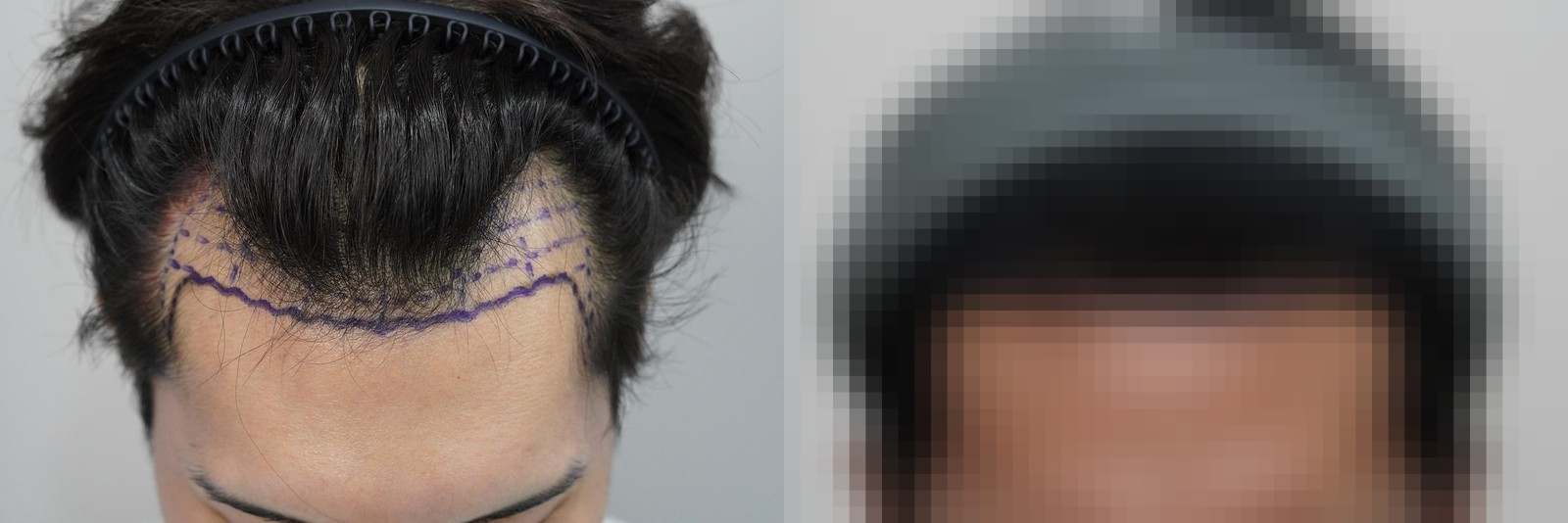 시술 전과 수술 1년 후 모발 상태 비교