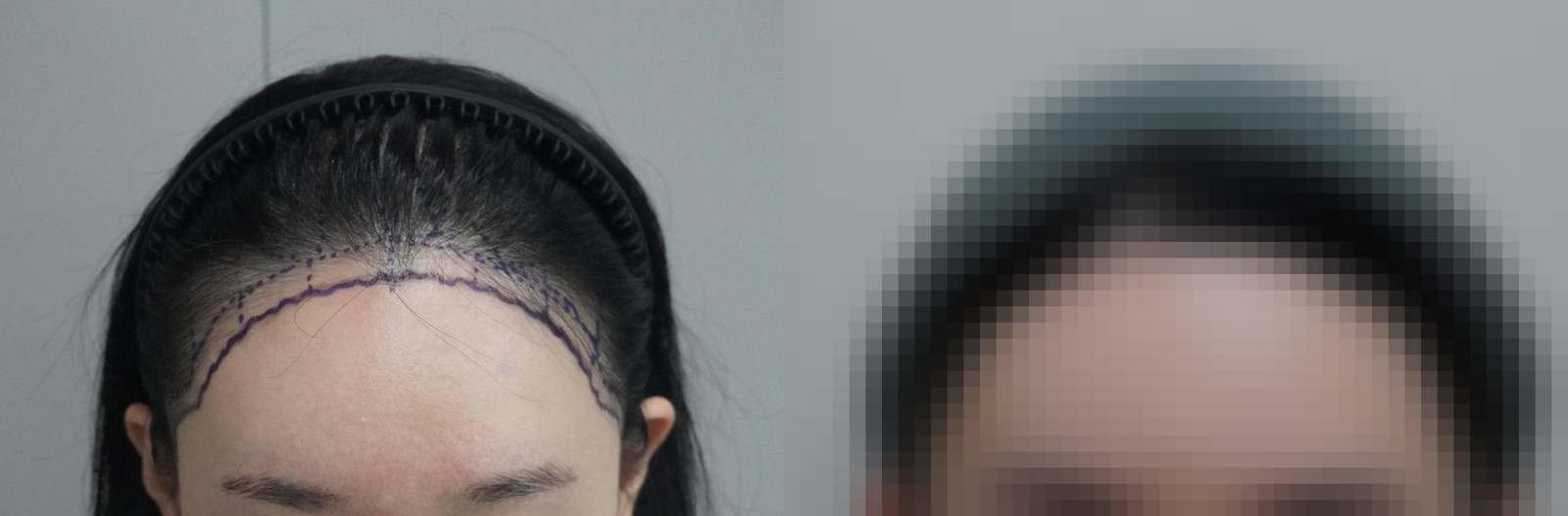 시술 전과 수술 1년 후 모발 상태 비교