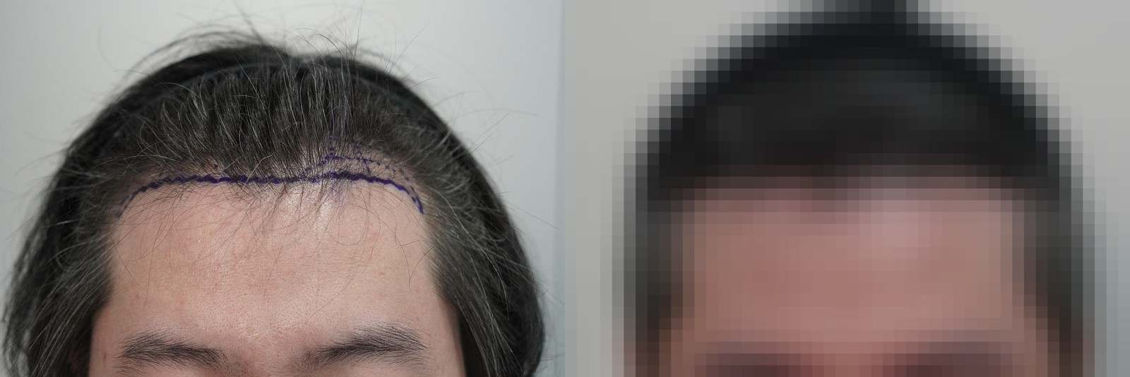 시술 전과 수술 1년 후 모발 상태 비교