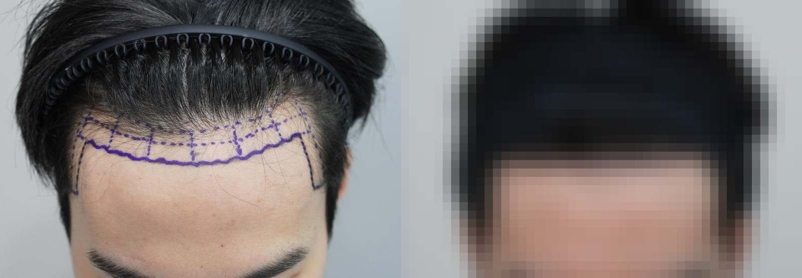 시술 전과 수술 1년 후 모발 상태 비교