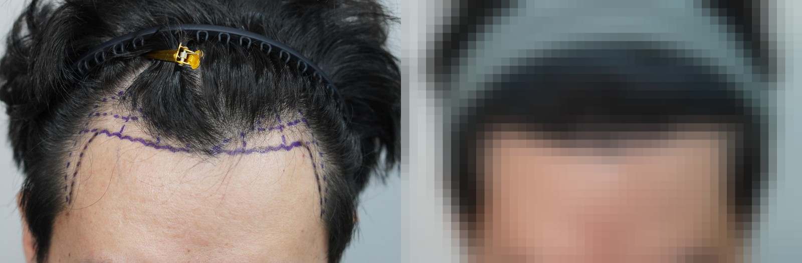 시술 전과 수술 1년 후 모발 상태 비교