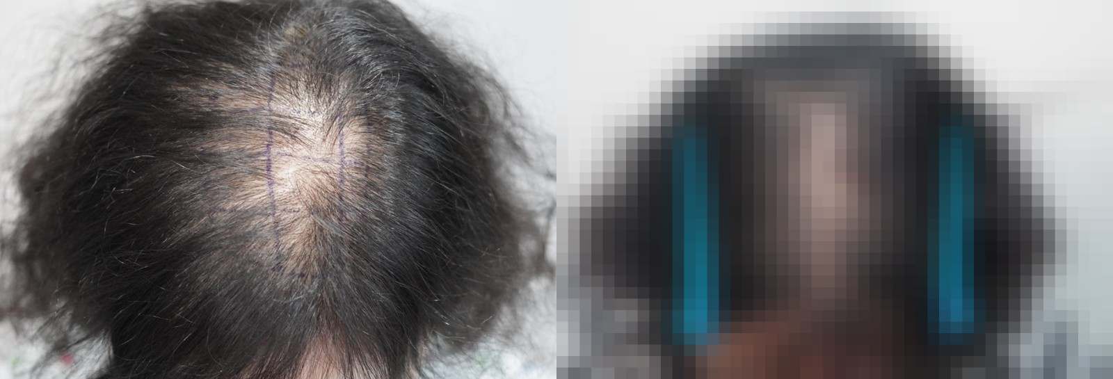 시술 전과 수술 1년 후 모발 상태 비교