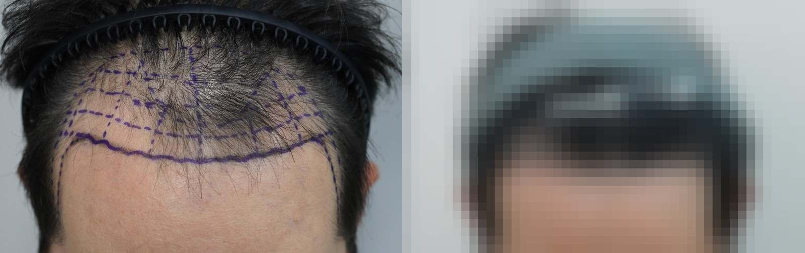 시술 전과 수술 1년 후 모발 상태 비교