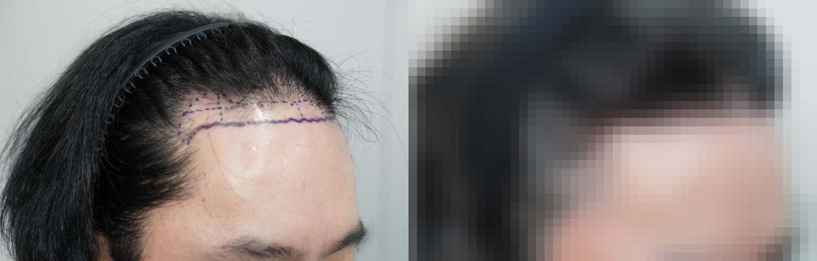 시술 전과 수술 1년 후 모발 상태 비교