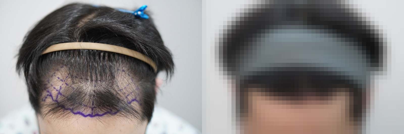 시술 전과 수술 1년 후 모발 상태 비교