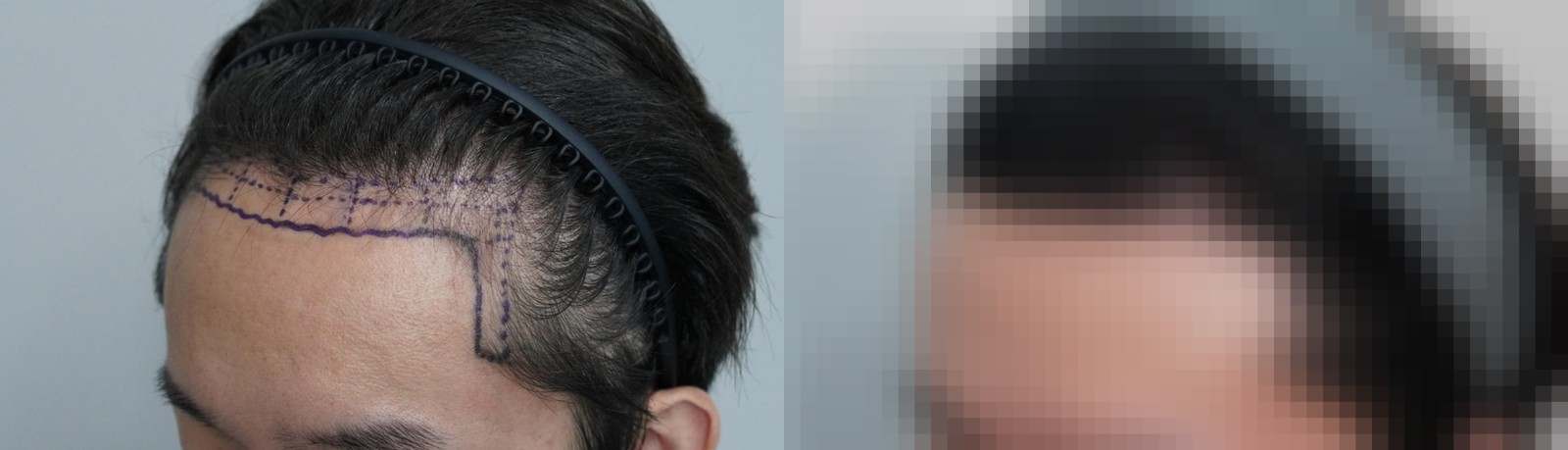 시술 전과 수술 1년 후 모발 상태 비교