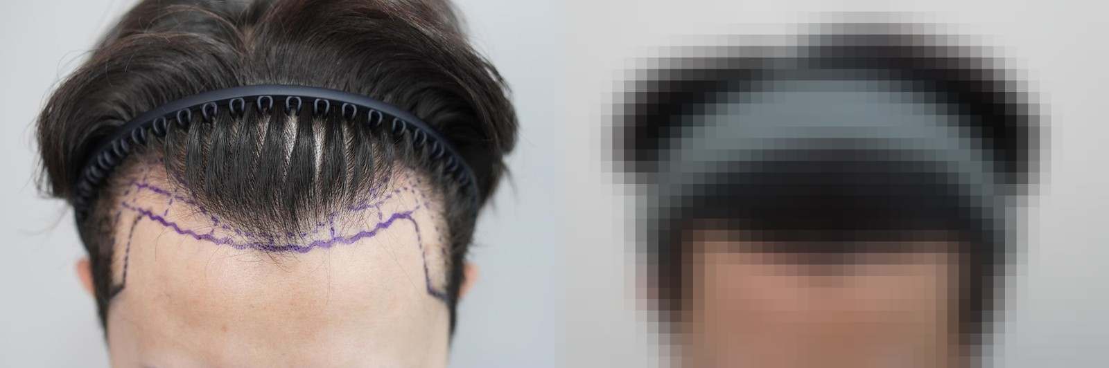 시술 전과 수술 1년 후 모발 상태 비교