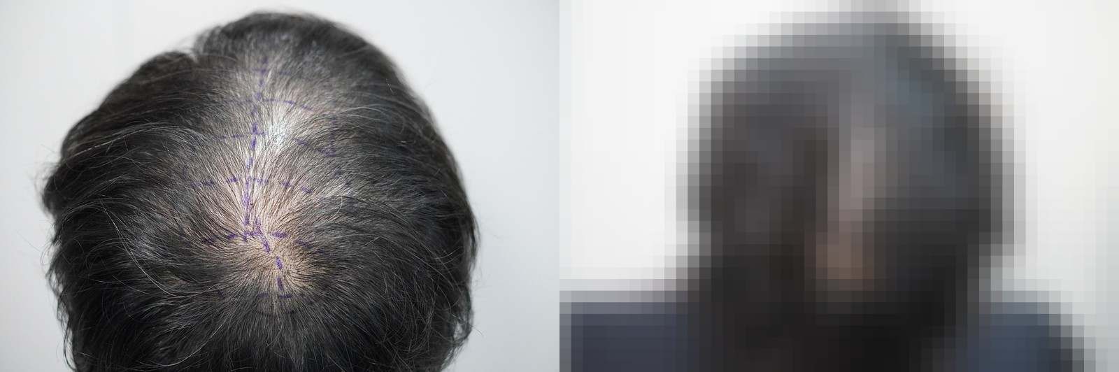 시술 전과 수술 1년 후 모발 상태 비교