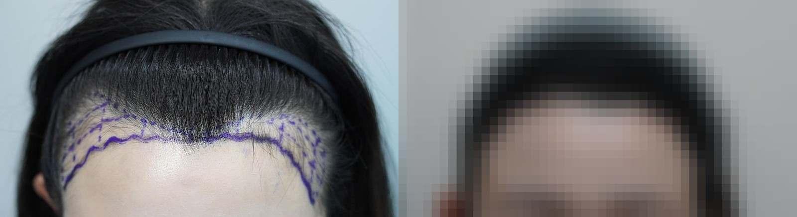 시술 전과 수술 1년 후 모발 상태 비교