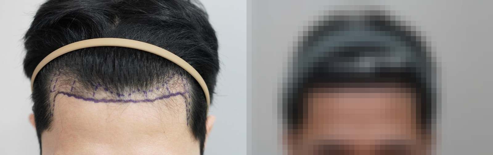 시술 전과 수술 1년 후 모발 상태 비교