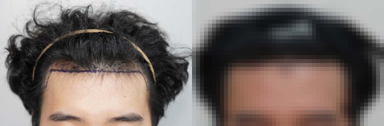 시술 전과 수술 1년 후 모발 상태 비교