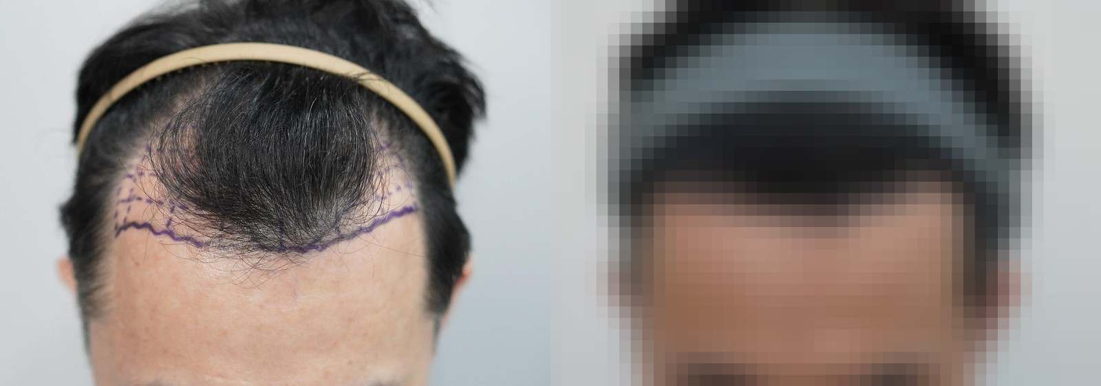 시술 전과 수술 1년 후 모발 상태 비교