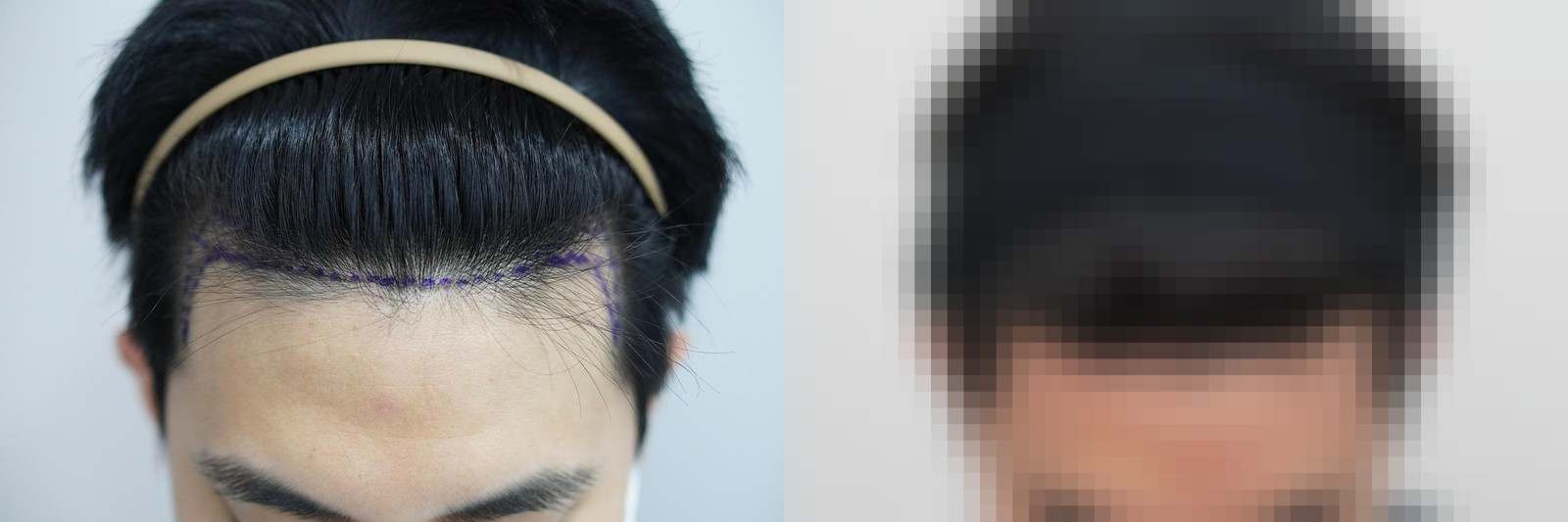 시술 전과 수술 1년 후 모발 상태 비교