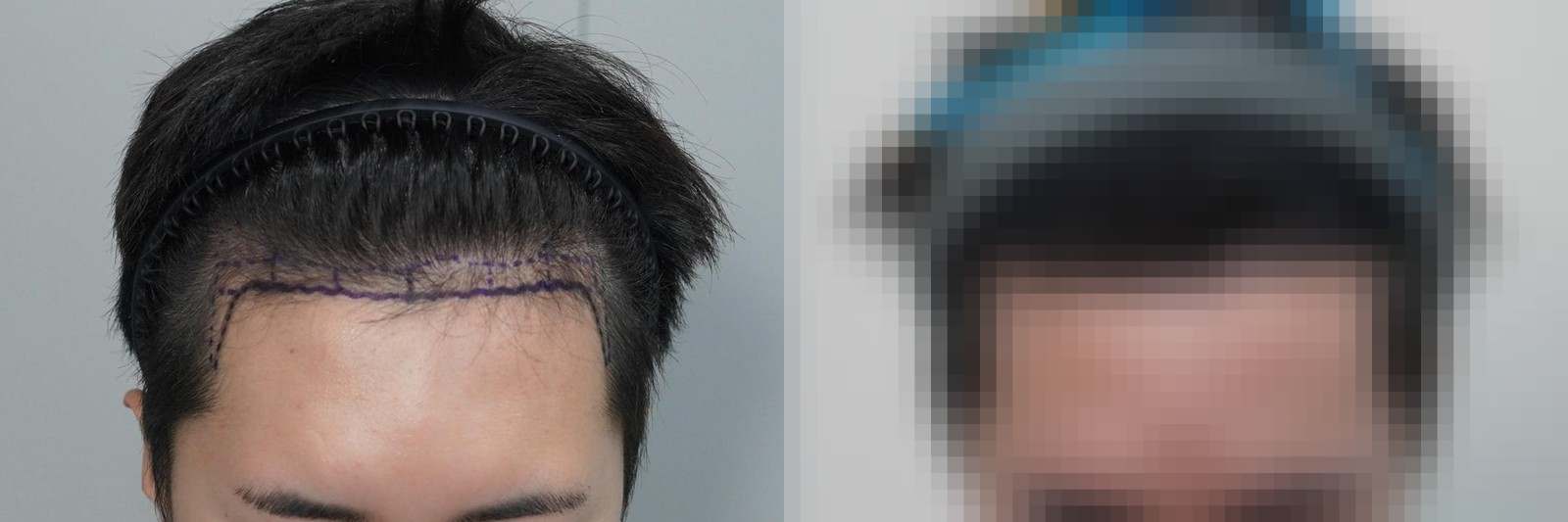 시술 전과 수술 1년 후 모발 상태 비교