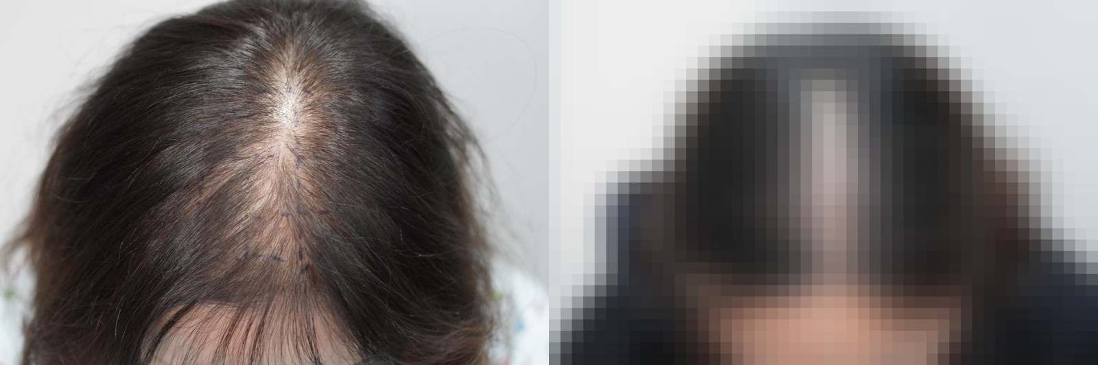 시술 전과 수술 1년 후 모발 상태 비교