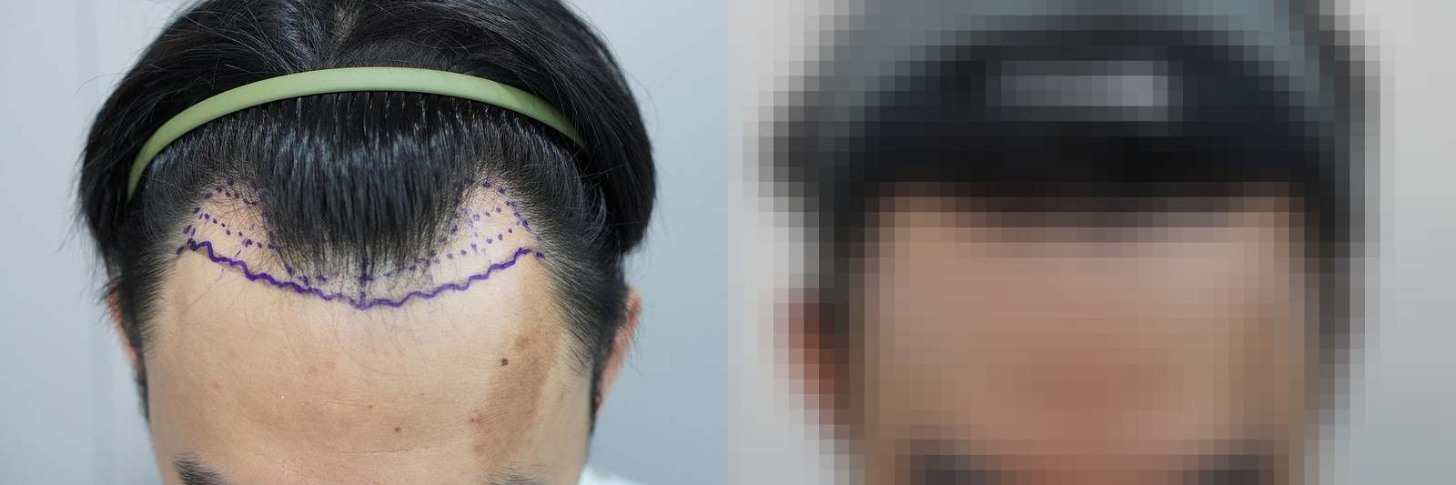 시술 전과 수술 1년 후 모발 상태 비교